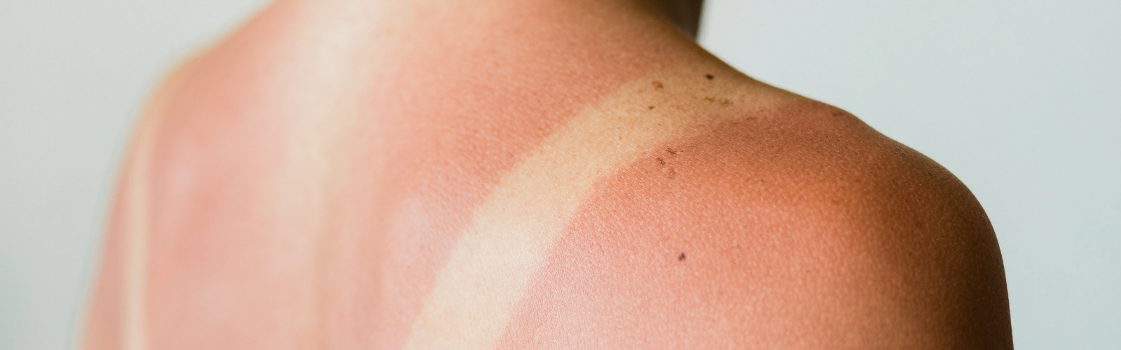 mujer con la piel enrojecida por una quemadura solar sobre fondo blanco