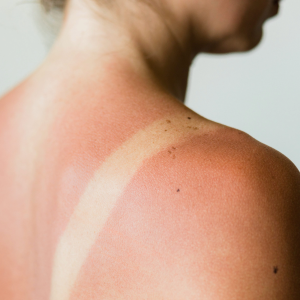 mujer con la piel enrojecida por una quemadura solar sobre fondo blanco